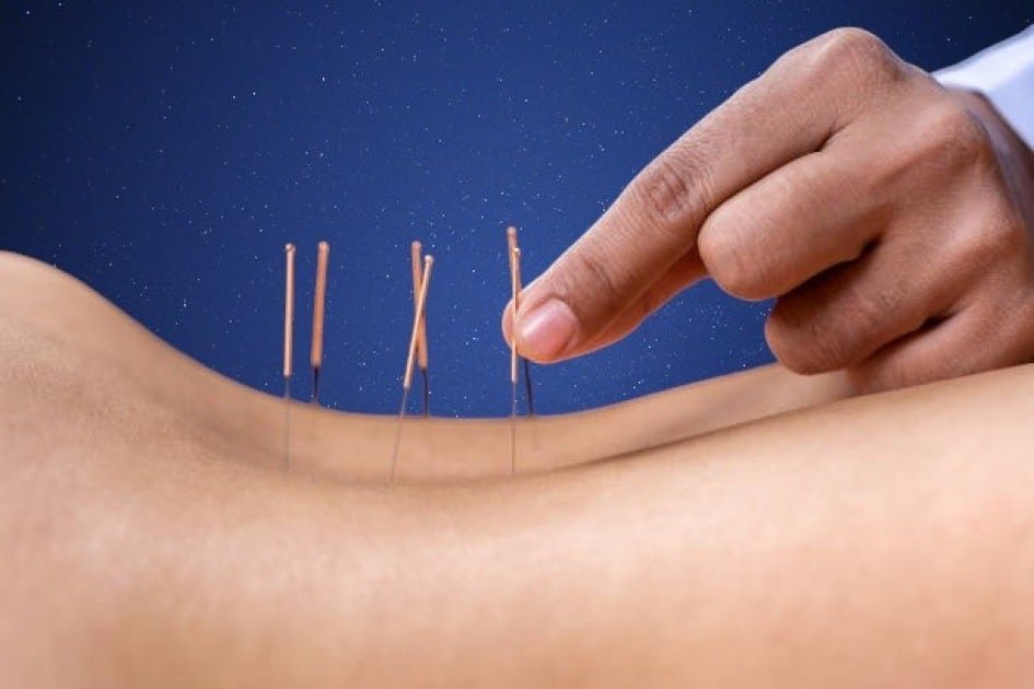 Personalized acupuncture session for holistic healing and pain relief