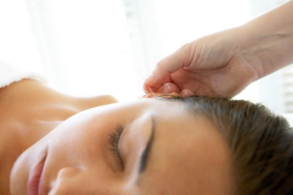 Close-up of acupuncture needles in a patient's back for natural pain relief therapy.