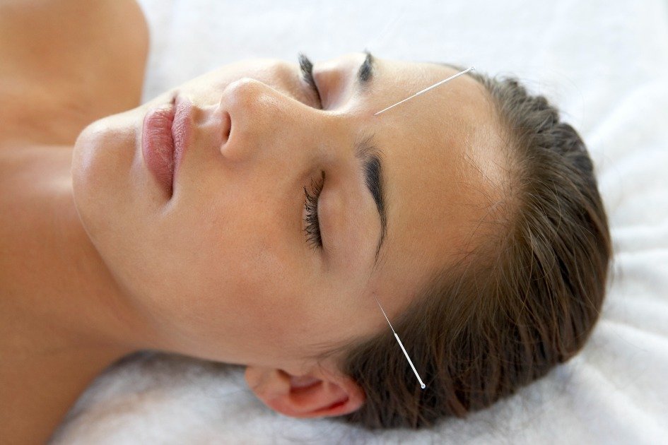 Close-up of acupuncture needles relieving pain naturally