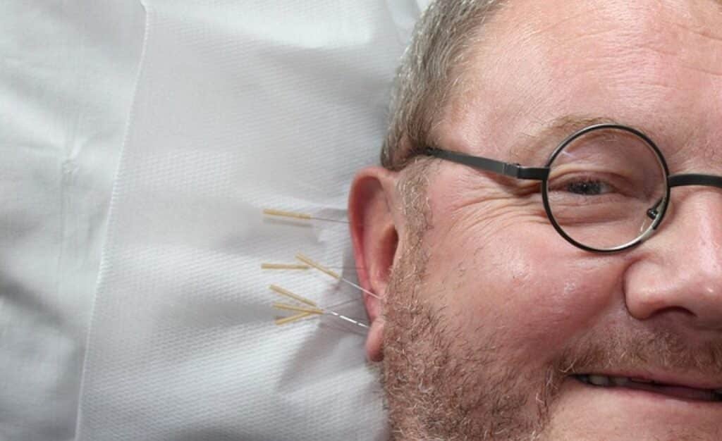 Close-up of acupuncture needles promoting full-body wellness and balance