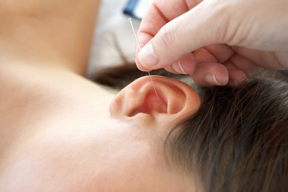 Acupuncture treatment session focusing on holistic healing and energy balance.