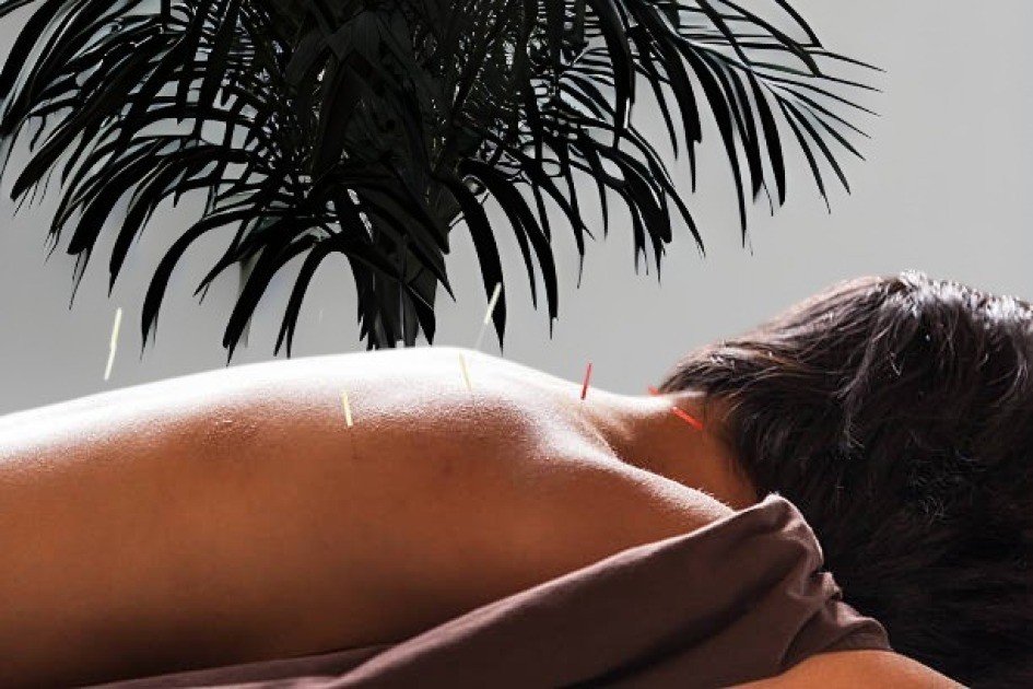 Close-up of acupuncture needles easing stress and anxiety in a serene wellness setting