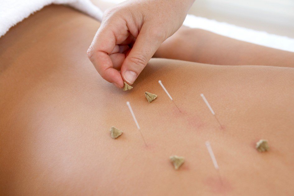 Acupuncture session offering natural, long-term pain relief.