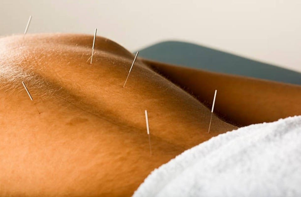 Close-up of an acupuncture needle being gently inserted into a patient’s skin during a therapy session.